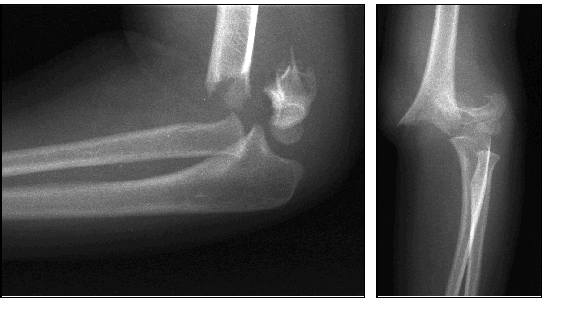Knochenbrüche am Ellbogen